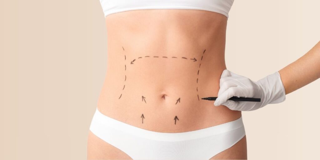 κοιλιοπλαστική